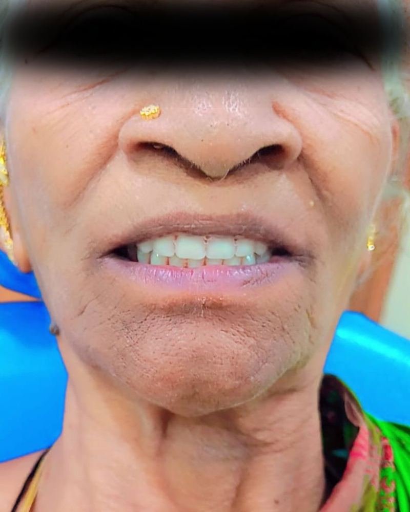Complete Denture Case 1 — after treatment at AVPR Dental Hospital