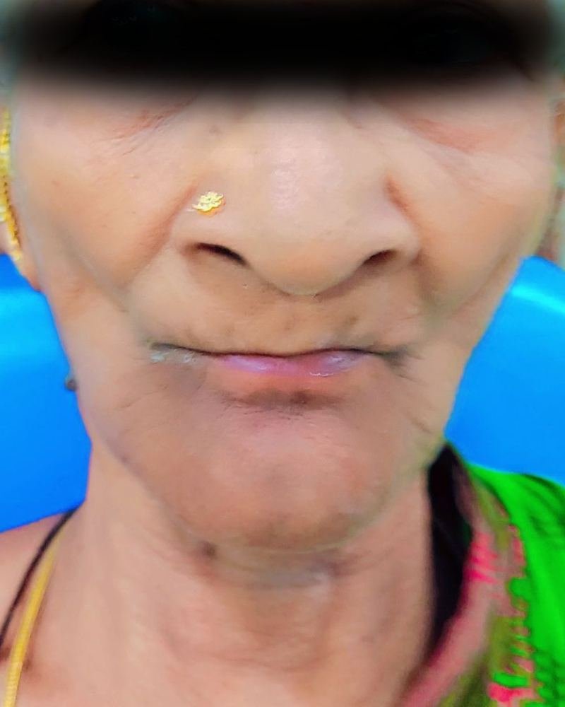 Complete Denture Case 1 — before treatment at AVPR Dental Hospital