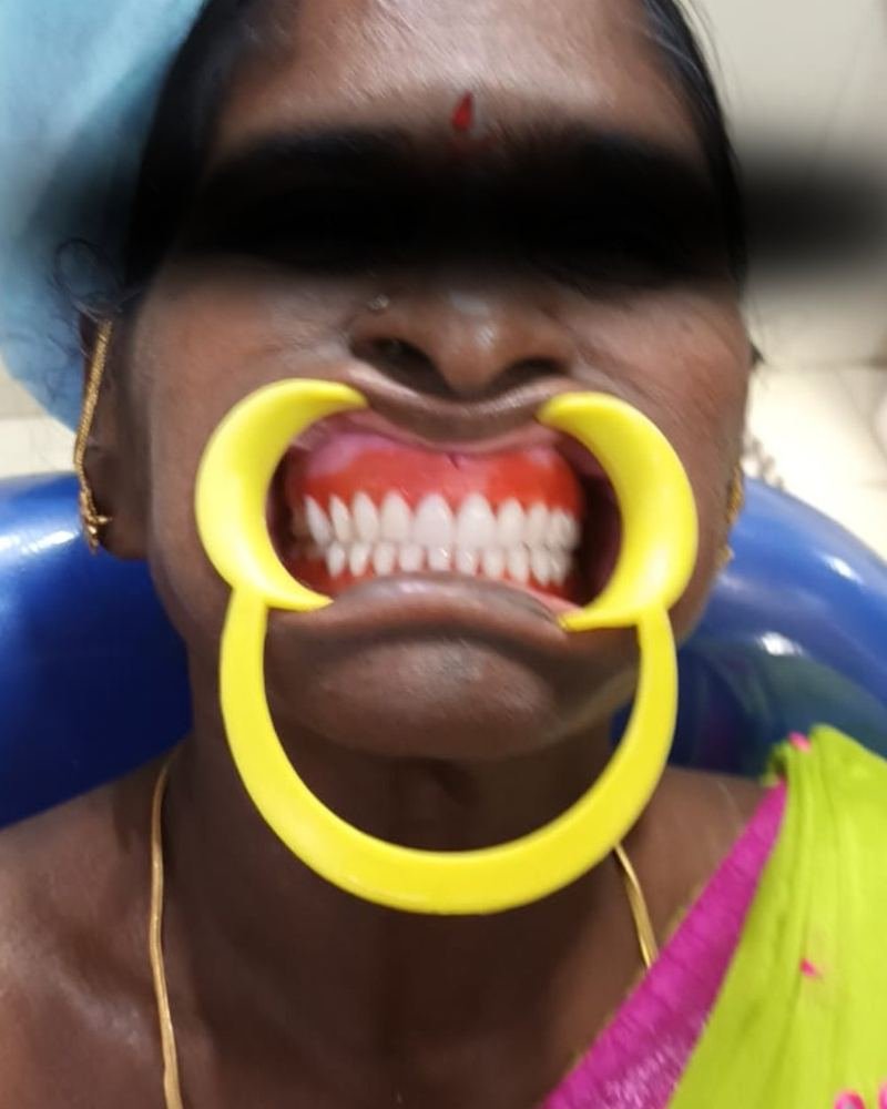 Complete Denture Case 2 — after treatment at AVPR Dental Hospital