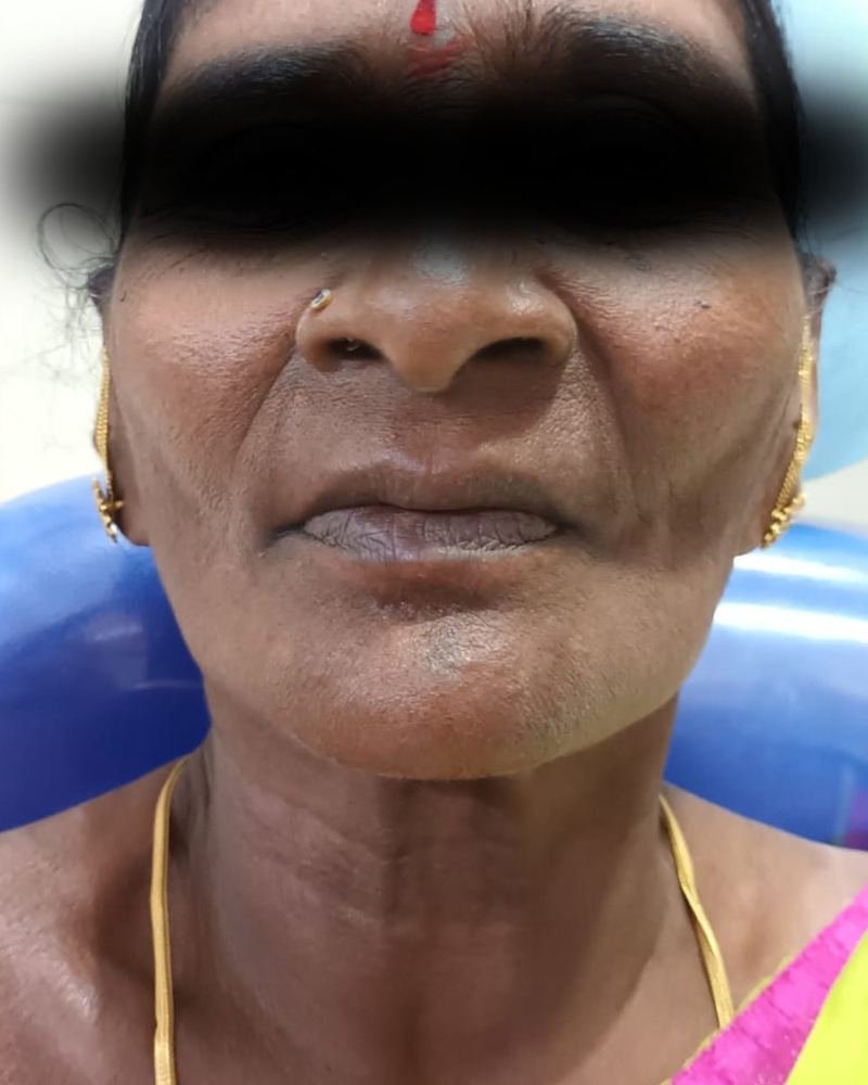 Complete Denture Case 2 — before treatment at AVPR Dental Hospital