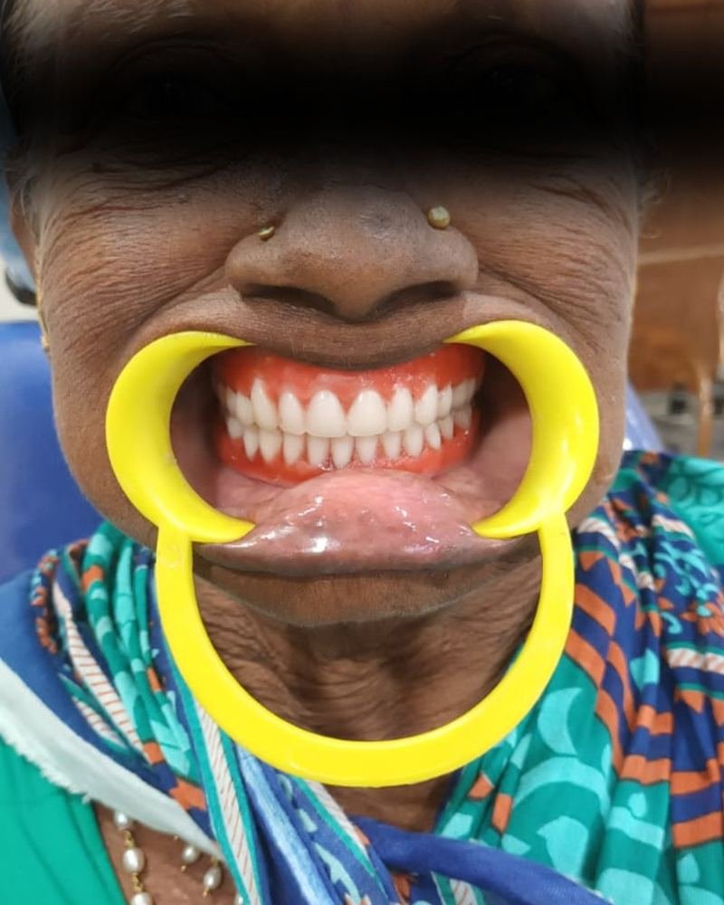 Complete Denture Case 3 — after treatment at AVPR Dental Hospital