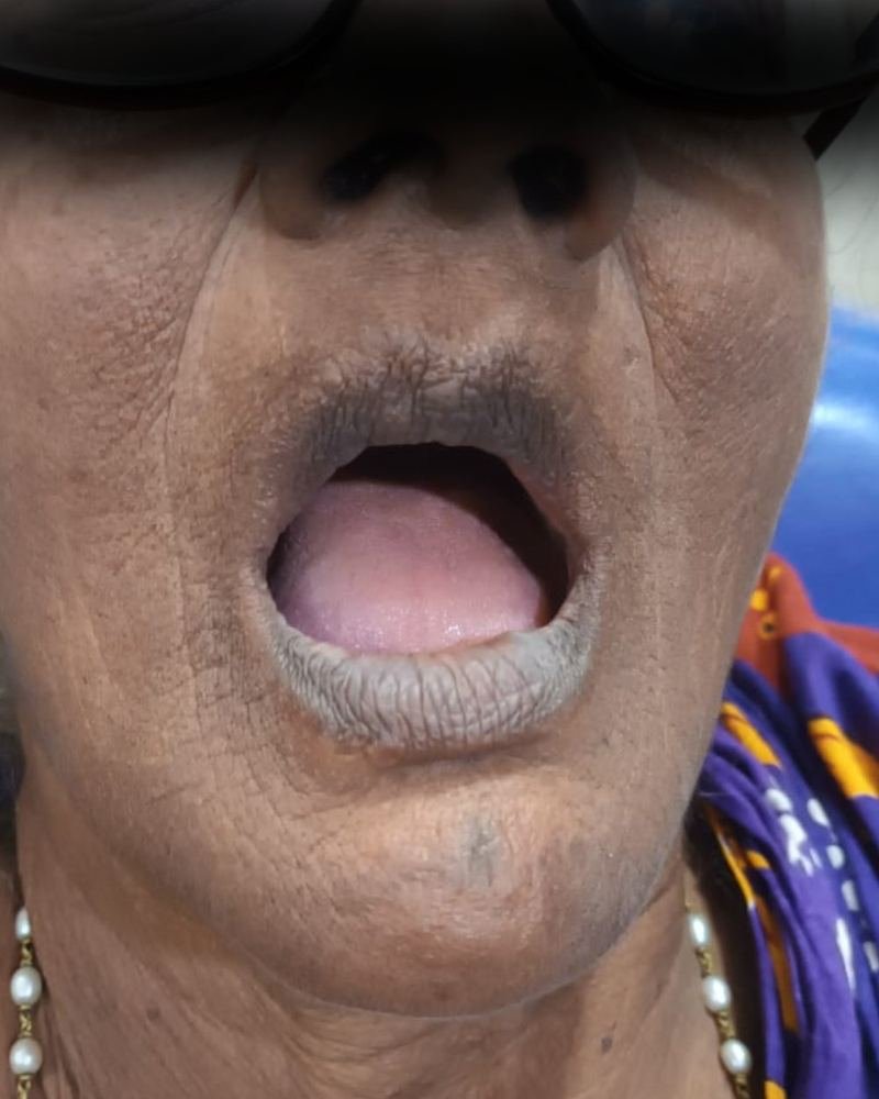 Complete Denture Case 3 — before treatment at AVPR Dental Hospital