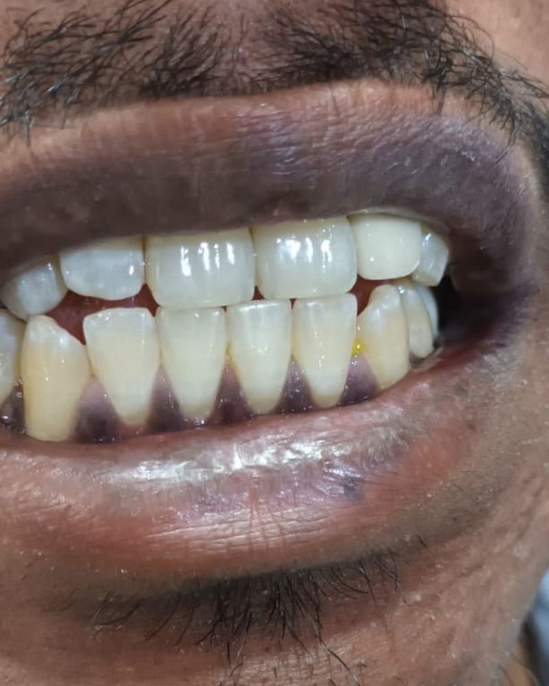 Front Tooth Crown — after treatment at AVPR Dental Hospital