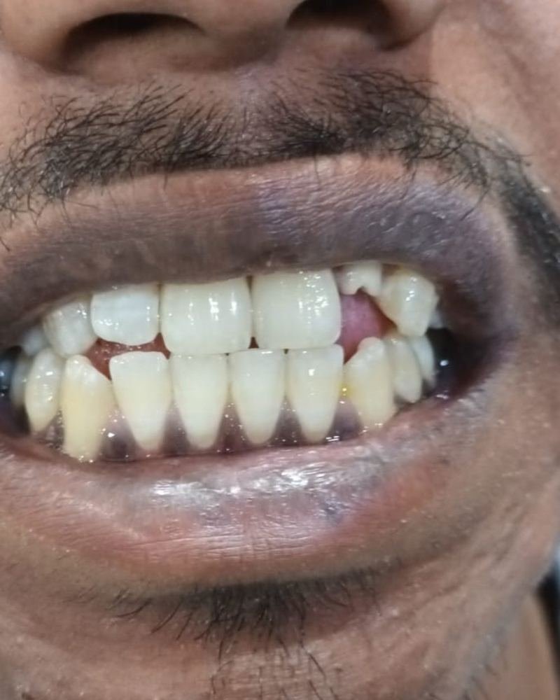 Front Tooth Crown — before treatment at AVPR Dental Hospital