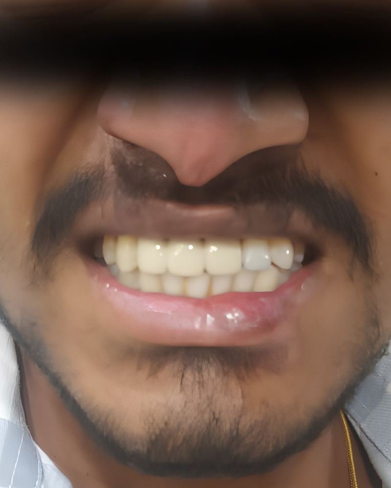 Missing Tooth Case 1 — after treatment at AVPR Dental Hospital