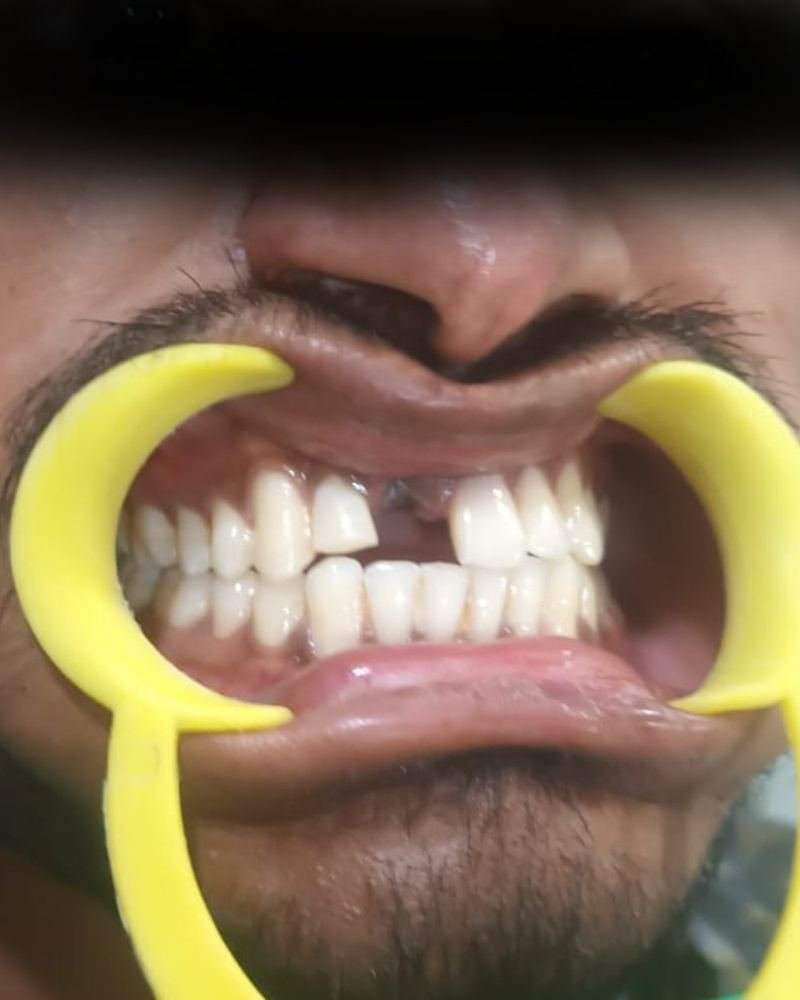 Missing Tooth Case 1 — before treatment at AVPR Dental Hospital