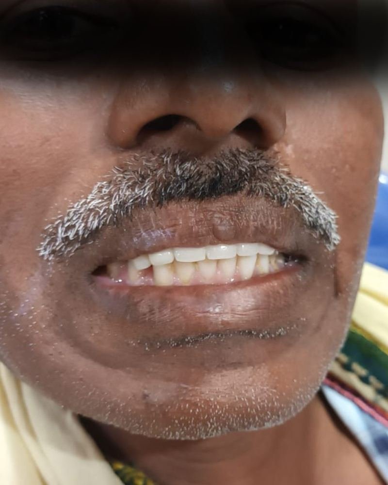 Missing Tooth Case 2 — after treatment at AVPR Dental Hospital
