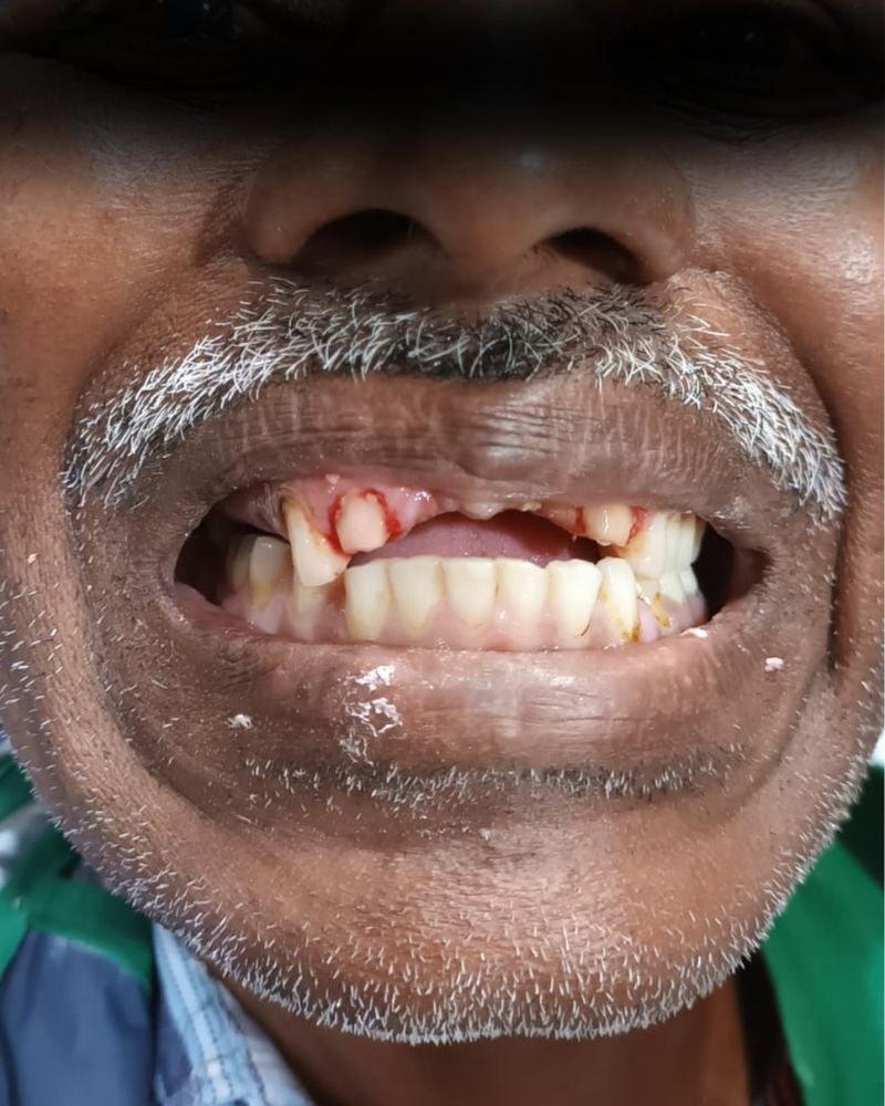 Missing Tooth Case 2 — before treatment at AVPR Dental Hospital