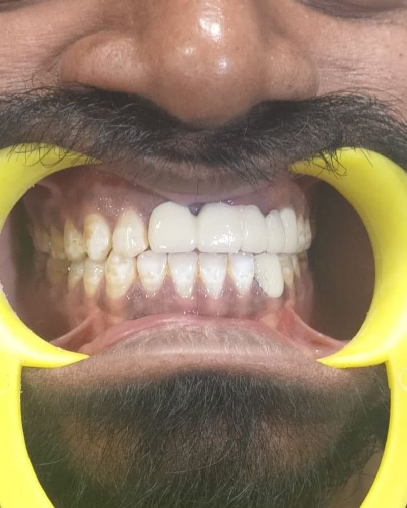 Missing Tooth Case 3 — after treatment at AVPR Dental Hospital