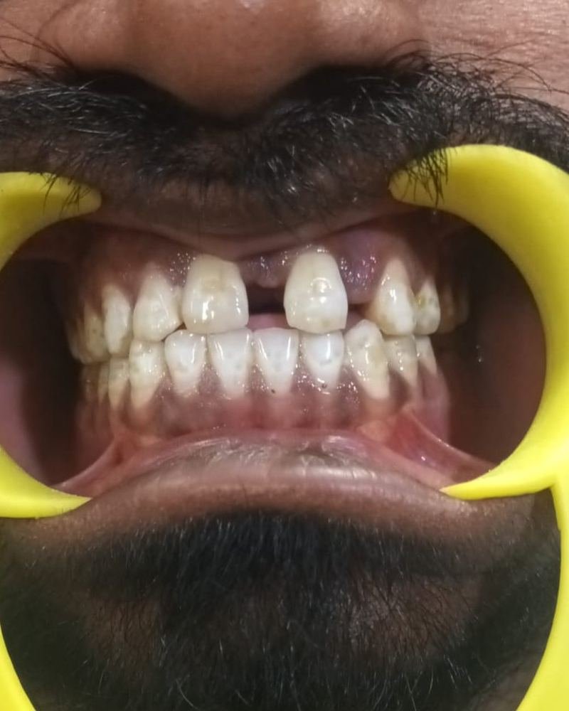 Missing Tooth Case 3 — before treatment at AVPR Dental Hospital