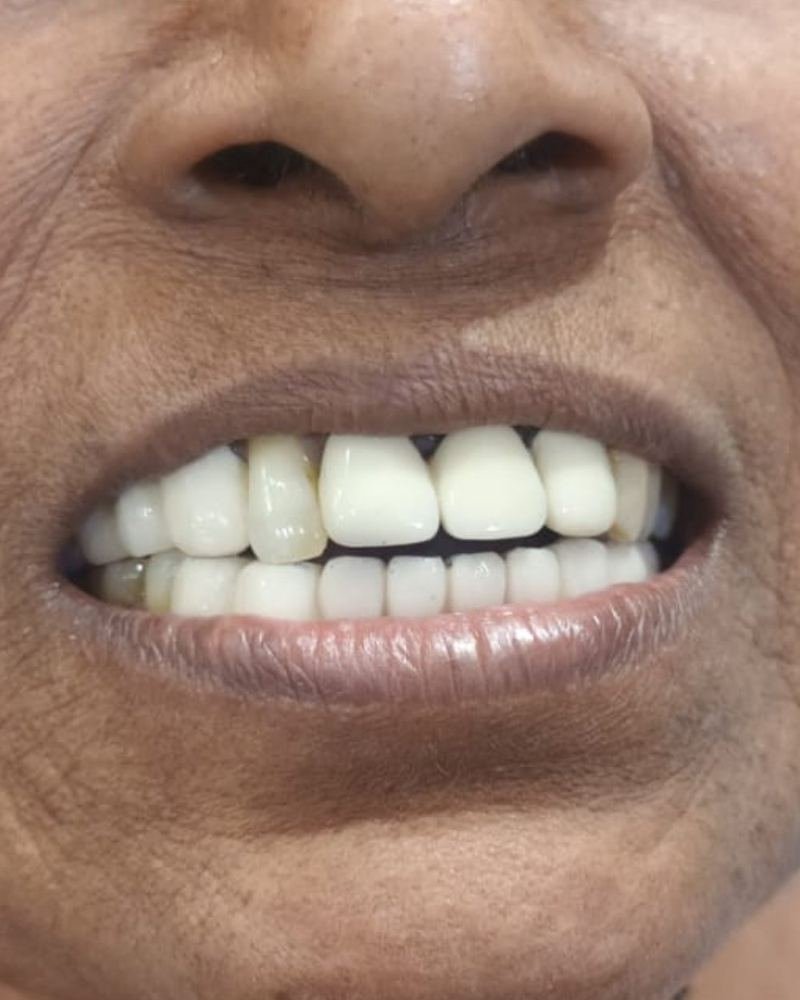 Missing Tooth Case 4 — after treatment at AVPR Dental Hospital