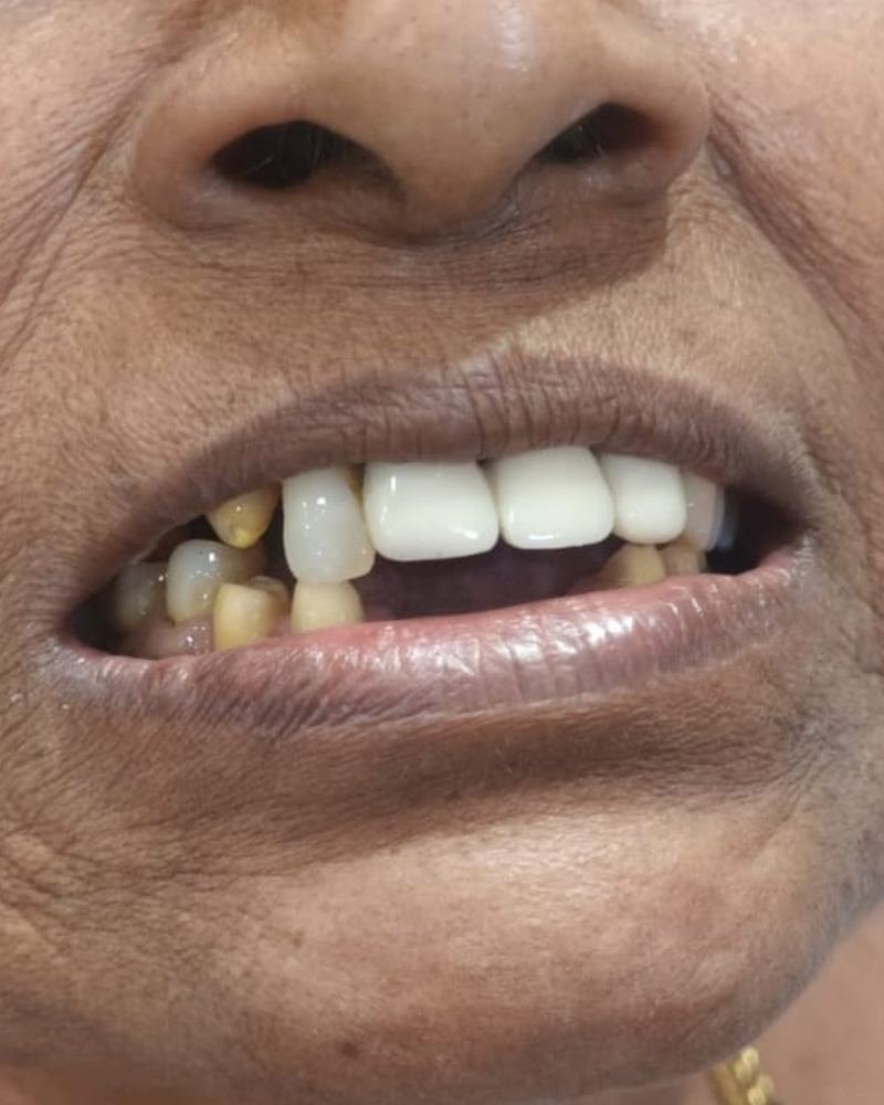 Missing Tooth Case 4 — before treatment at AVPR Dental Hospital